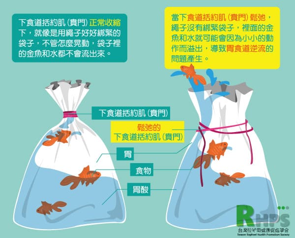  胃食道逆流的原因？  