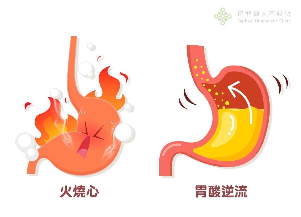 胃食道逆流 非典型症狀 胃食道逆流典型症狀：胸口灼熱（火燒心）、胃酸逆流  