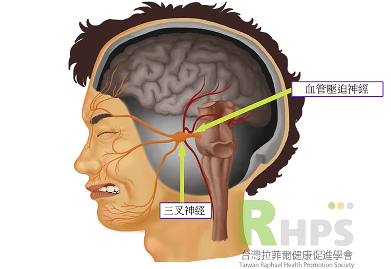 什麼是三叉神經痛?  